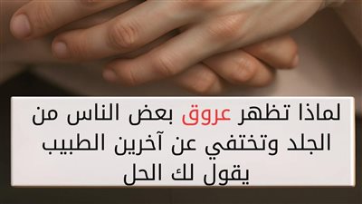 لماذا تظهر عروق عند بعض الناس وتختفي عند الأخرين